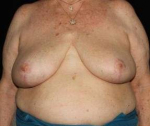 Breast Reduction - Case #5 After